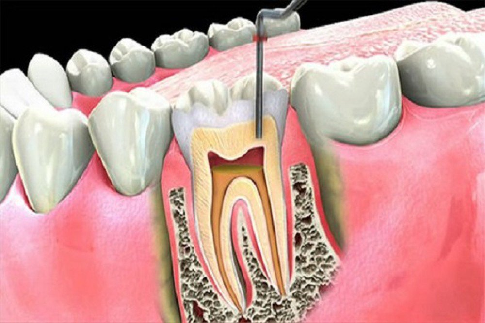 viêm tủy răng 2